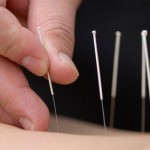 acupuncture